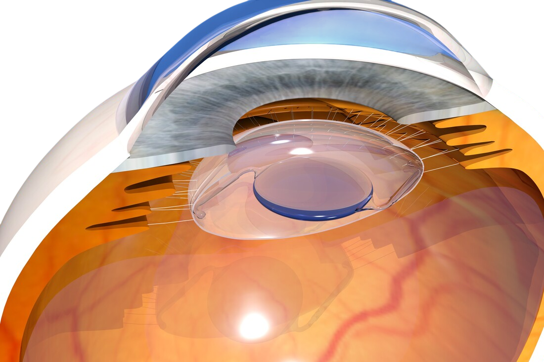 Shows the eye after a successful cataract surgery by Stephanie West in the UK