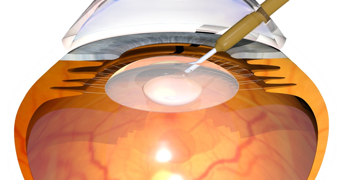 Cataract surgery to fix eye condition in the UK