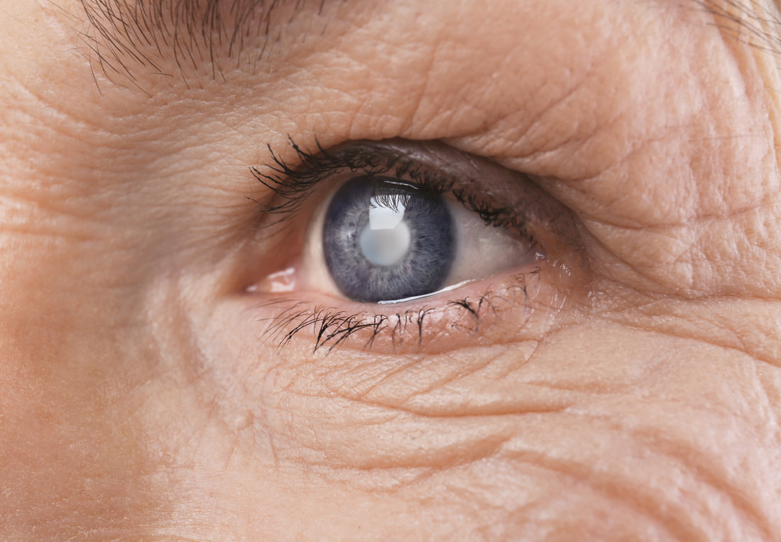 Cataract Eye Condition specialist in the UK