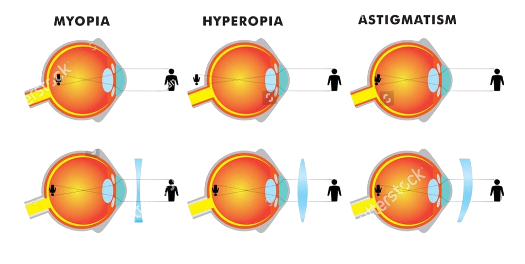 Refractive Errors eyesight disorders in Children in the UK